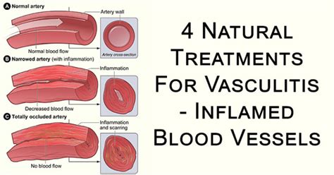 4 Natural Treatments For Vasculitis Inflamed Blood Vessels David