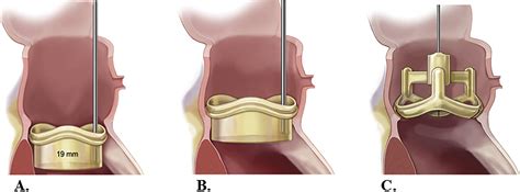 Step By Step Aortic Valve Replacement With A New Rapid Deployment Valve
