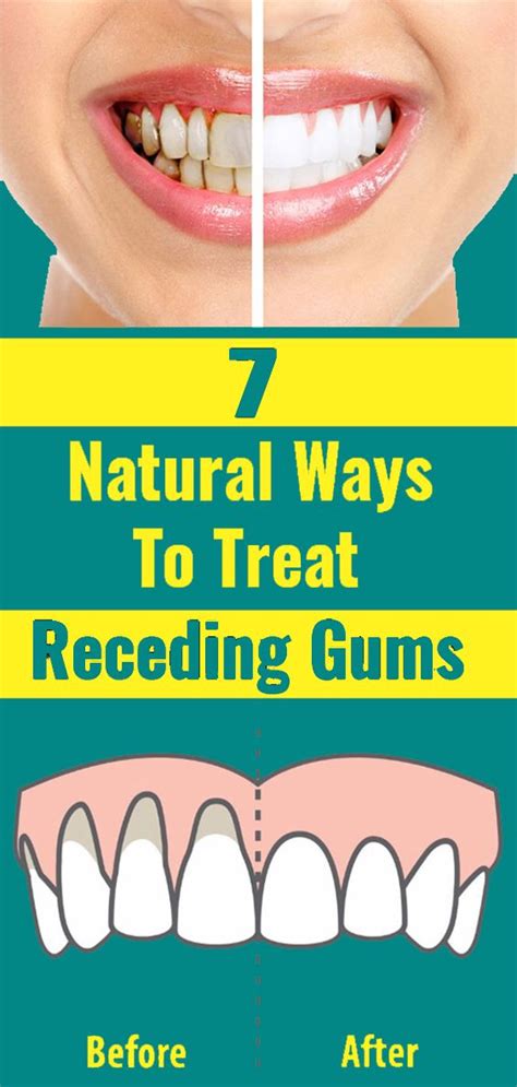 Treat Receding Gums In 2020 Receding Gums Oral Health Care Turmeric