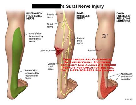 Sural Nerve Anatomy Anatomical Charts And Posters