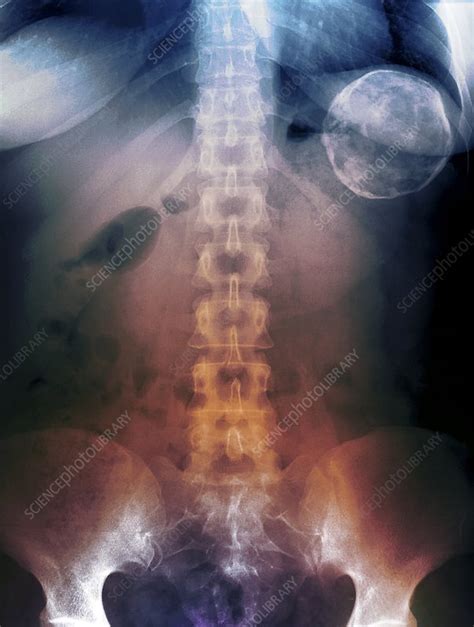 Cyst Of The Spleen X Ray Stock Image C0041502 Science Photo Library