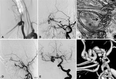 Frontiers Cerebrovascular Disorders Associated With Agenesis Of The Internal Carotid Artery