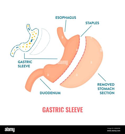 Gastric Sleeve Bariatric Surgery Illustration Stock Photo Alamy