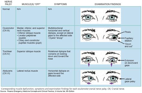 Cranial Nerve Palsy Cn Iii Iv Vi Vii Palsy Off