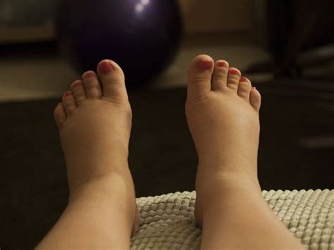 Home Remedies For Swelling In Feet 10 Ways To Reduce Swollen Feet