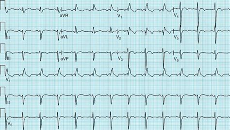 Bifascicular Block Causes Symptoms Diagnosis And Treatment