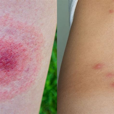Types Of Mosquito Bites Pictures Peepsburghcom