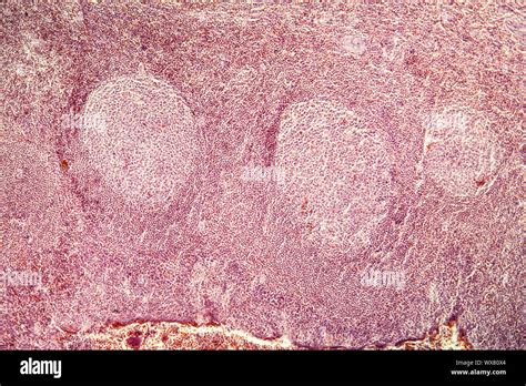 Amigdalitis Tejido Enfermo Bajo El Microscopio 100x Fotografía De Stock