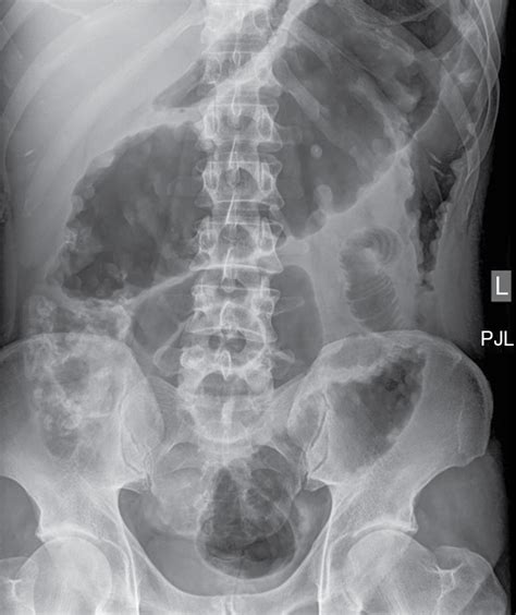 Abdominal Radiographic Anatomy Wikiradiography Radiol Vrogue Co
