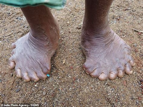 Thumb Believable Indian Woman With NINETEEN Toes And Fingers Sets New World Record Daily