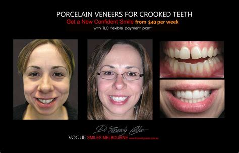 Porcelain Veneers Versus Invisalign Which Is The Best