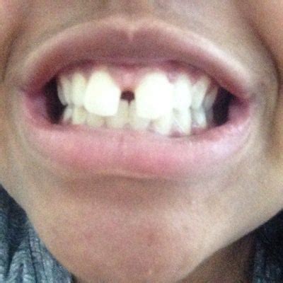 However, the invisalign option offers a number of advantages — especially cosmetic ones — over standard braces. How long will it take to fix a large gap with Braces ...