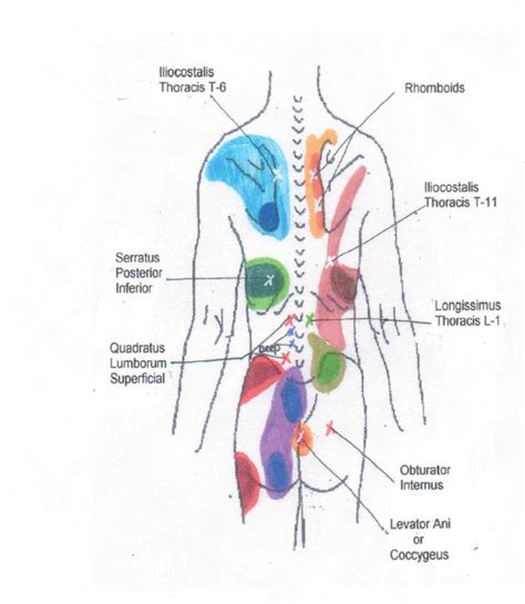 Trigger Point Referred Pain Chart