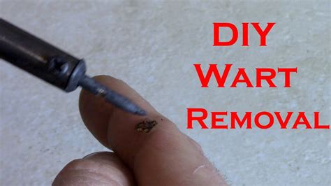 How To Remove A Wart At Home With A Soldering Iron Youtube