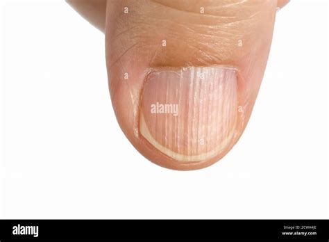 Vertical Ridges On Fingernails Symptoms Deficiency Stock Photo Edit