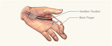 Trigger Finger Stenosing Tenosynovitis Usa Spine Care And Orthopedics