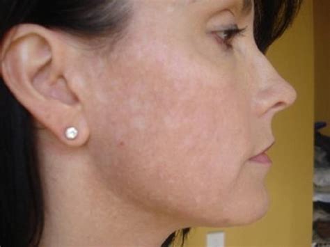 Белые пятна на коже лица у взрослых почему появляются как лечить