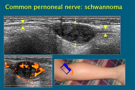 Peripheral Nerve Lesions Role Of High Resolution Us Radiographics