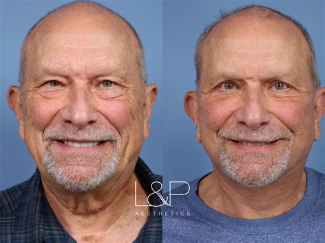 Before And After Photos Of A Male Facelift
