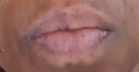Skin Around Lips Is White