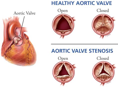 Aortic Valve Stenosis Causes Symptoms Life Expectancy Treatment