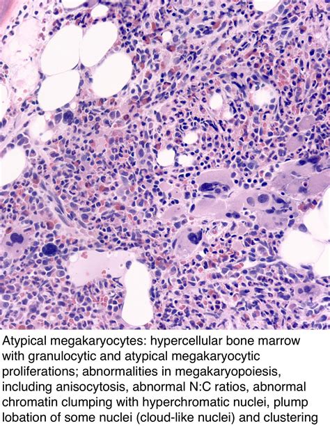 Pathology Outlines Primary Myelofibrosis