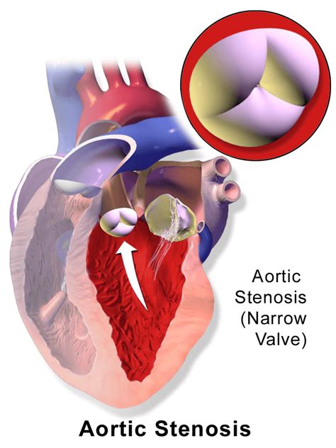 Aortic Stenosis Explained Pathology 101 For Patients