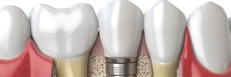 Dental Implants What You Need To Know Dental Implants Greeley Co