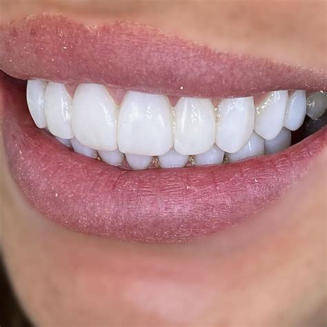 What Is Composite Bonding Before And After 3dental
