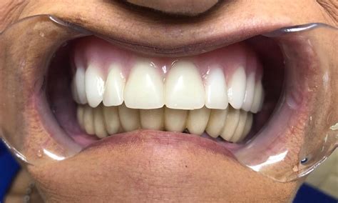 6 Upper Partial Dentures Pictures Lesleyanncruz