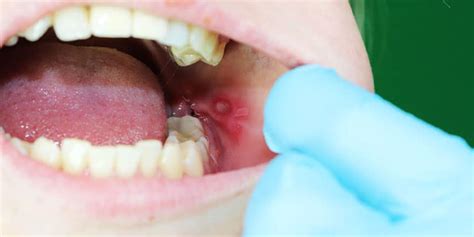 How To Treat Canker Sores Yonge Eglinton Dental