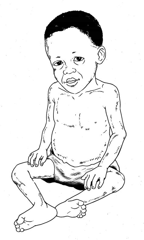 Sick Baby Health Care Malnourished Baby 6 24 Mo 00 Non Country