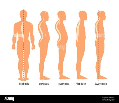 Medical Illustration Of Spinal Deformity Types Scoliosis Lordosis And