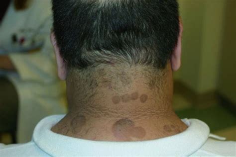 Image Tinea Versicolor With Multiple Brown Patches On The Neck Msd