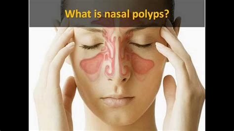 Nasal Polyps How Nasal Polyps Treatment Miracle Helps People Treat Sexiz Pix