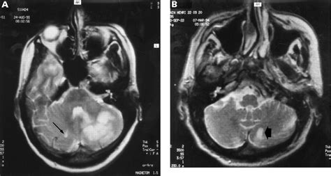 Multiple Large And Small Cerebellar Infarcts Journal Of Neurology