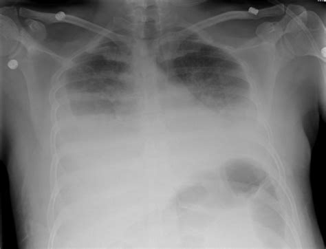It is commonly referred to as fluid around the lungs or water surrounding the lungs. Pleural Effusion - Undergraduate Diagnostic Imaging ...