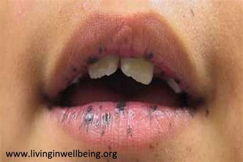 Black Spots On Lips What Should You Do Living In Well Being
