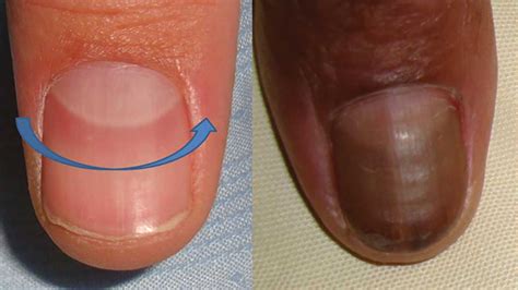 Red Lines Under Nails Associated Symptoms And Signs Include