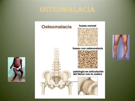 Osteomalacia Is A Metabolic Disease Characterized By Inad
