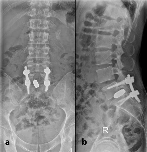 Cureus Revision Spinal Surgery For Posterior Migration Of Tantalum