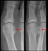 Pictures of Tibial Sesamoid Fracture Treatment