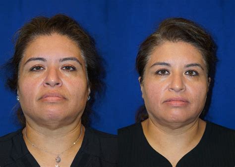 Evoke By Inmode Facial Remodeling Cosmetic Procedures Santa Barbara