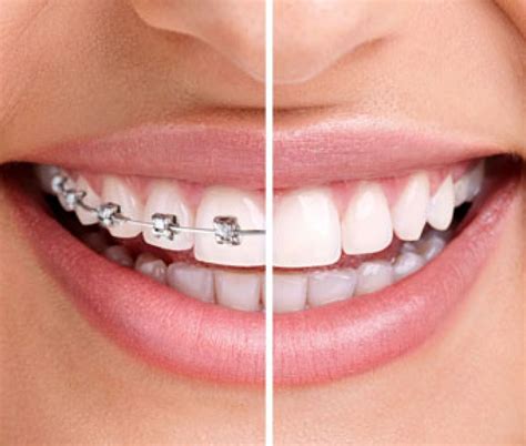 Many people wonder how to clean invisalign retainers and aligners at home. Invisalign Clear Aligners Surrey BC | Hanin Dental Surrey