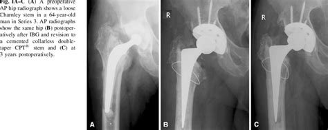 Ac A A Preoperative Ap Hip Radiograph Shows A Loose Charnley Stem In
