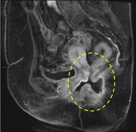 Imaging And Surgical Management Of Anorectal Vaginal Fistulas Radiographics