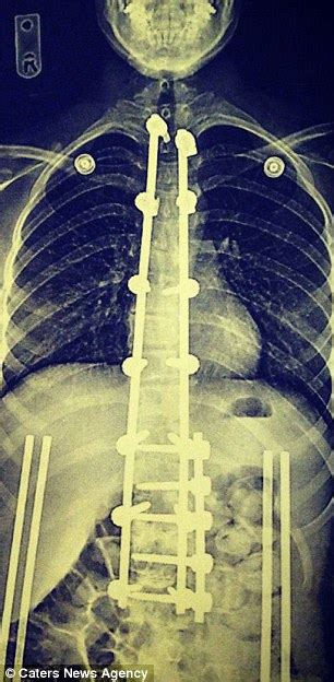 Teenager Overcomes Crippling Scoliosis Spinal Condition To Become A