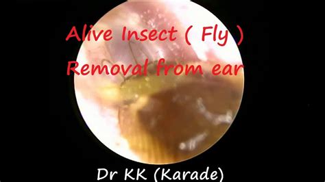 Alive Insect Fly Removal From Ear Youtube