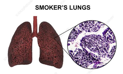 smoker s lungs illustration and light micrograph stock image f022 6857 science photo library