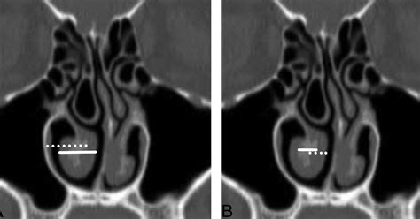 Nasal Turbinates Anatomy Ct Anatomy Structure